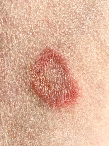 Ringworm infection on the arm af a caucasian adult male Ringworm infection on the arm of a caucasian adult male. This fungal skin infection causes itching, redness and scaly skin and the rings are called plaques. ringworm photos stock pictures, royalty-free photos & images