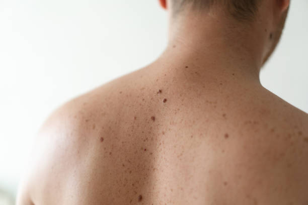 Close up detail of the bare skin on a man back with scattered moles and freckles Checking benign moles. Close up detail of the bare skin on a man back with scattered moles and freckles. Pigmentation. Birthmarks on skin mole stock pictures, royalty-free photos & images