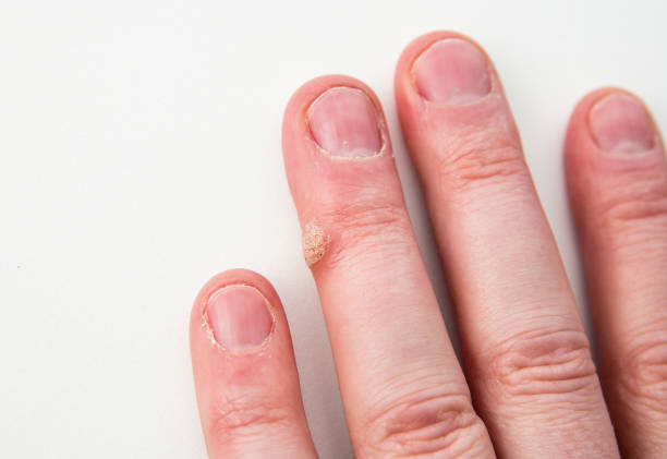 Close up view of skin disease called wart caused by human papilloma virus on human finger. stock photo