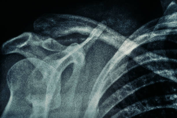 macro photo du vrai film de rayon x épaule humaine avec le grain de film - x ray x ray image shoulder human arm photos et images de collection