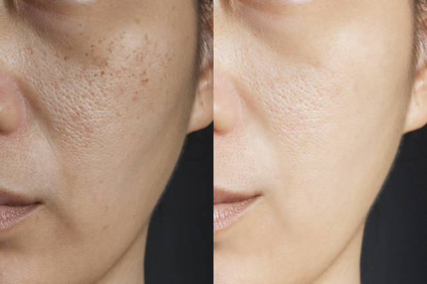 duas imagens comparam efeito antes e depois do tratamento. pele com problemas de sardas, poros, pele maçante e rugas antes e depois do tratamento para resolver problema de pele para melhor resultado da pele - wrinkled skin - fotografias e filmes do acervo