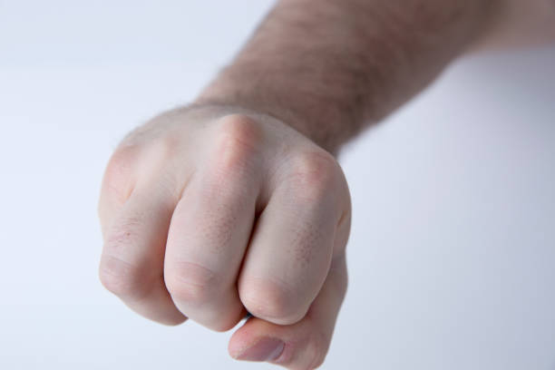 istock Missing Knuckle From Boxer's Fracture on Right Ring Finger 1299026656