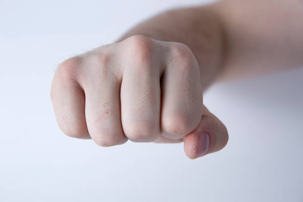 istock Missing Knuckle From Boxer's Fracture on Right Ring Finger 1299026657