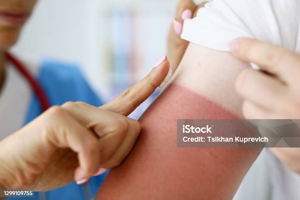 Nurse Applying Protective Cream To Skin Of Hand With Burn Closeup Stock Photo - Download Image Now