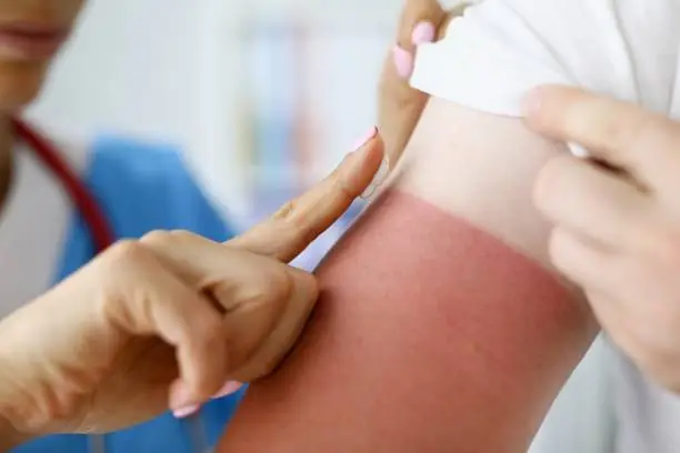 Nurse applying protective cream to skin of hand with burn closeup. Danger of sunburn concept