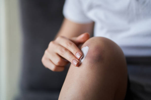 Close up of a person rubbing cream for healing injured knee joint. Bruise on the knee. Leg pain Close up of a person rubbing cream for healing injured knee joint. Bruise on the knee. Leg pain. knee contusion bruised knee stock pictures, royalty-free photos & images