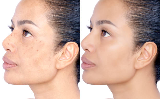 istock Before and after Healing and removing spot melasma pigmentation facial treatment. Problem of facial skin on middle age beauty Asia woman skin Cosmetology therapy concept. Headshot isolated on white. 1299275632
