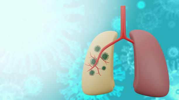 istock Coronavirus or COVID-19 in the lungs. 1299512518