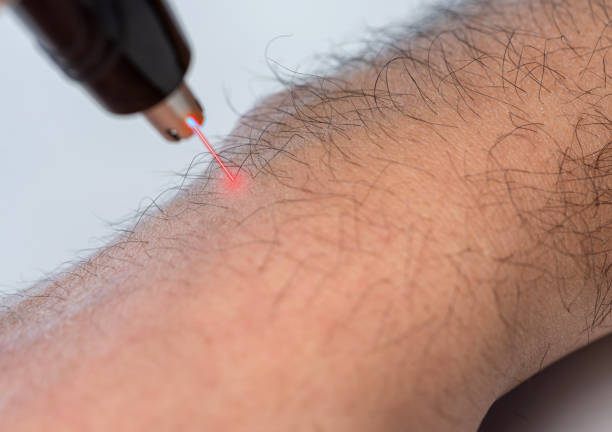 istock Removing body hair with laser epilation 1299577647