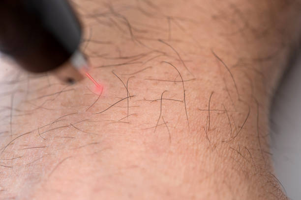 istock Removing body hair with laser epilation 1299578521