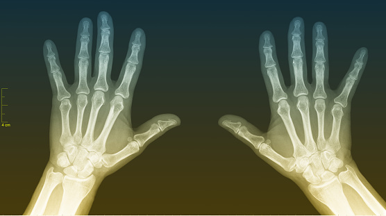 Radiology of left and right hand