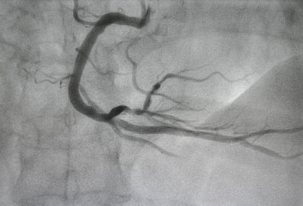 angiografía coronaria, imagen de rayos x. - surgery catheter cardiac catheterization hospital fotografías e imágenes de stock