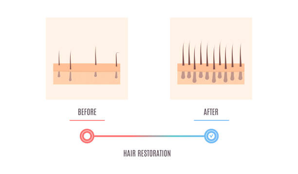 kuvapankkikuvitukset aiheesta päänahan ihon poikkileikkauskaavio, jossa näkyy hiusten restaurointitulos - receding hairline