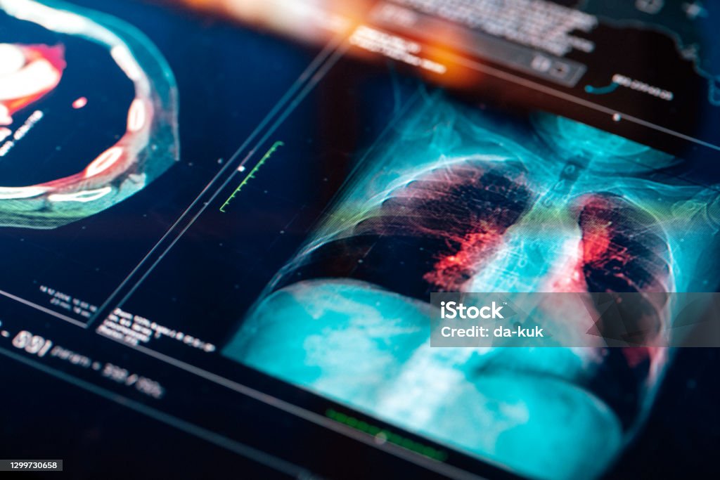 Medical MRI  Scan Medical MRI  Scan on digital screen Lung Cancer Stock Photo