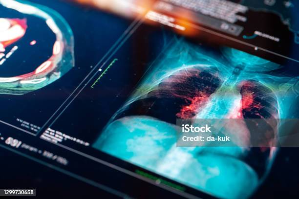 Medical Mri Scan Stock Photo - Download Image Now - Lung Cancer, Lung, Healthcare And Medicine