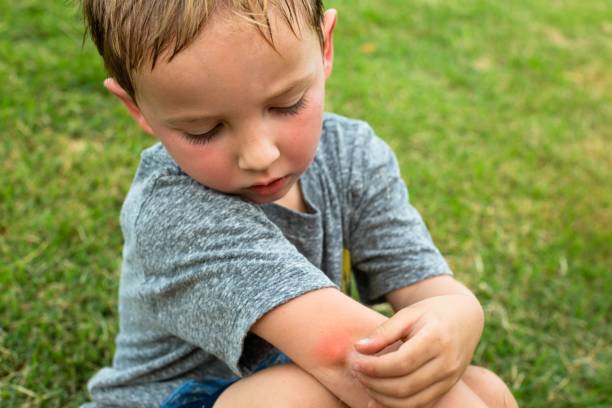 People with mosquitoes bites outdoor. Bug bites in tropical summer. A little boy scratching his arm from a red mosquito bite after playing outdoor in the tropical summer time. stinging photos stock pictures, royalty-free photos & images