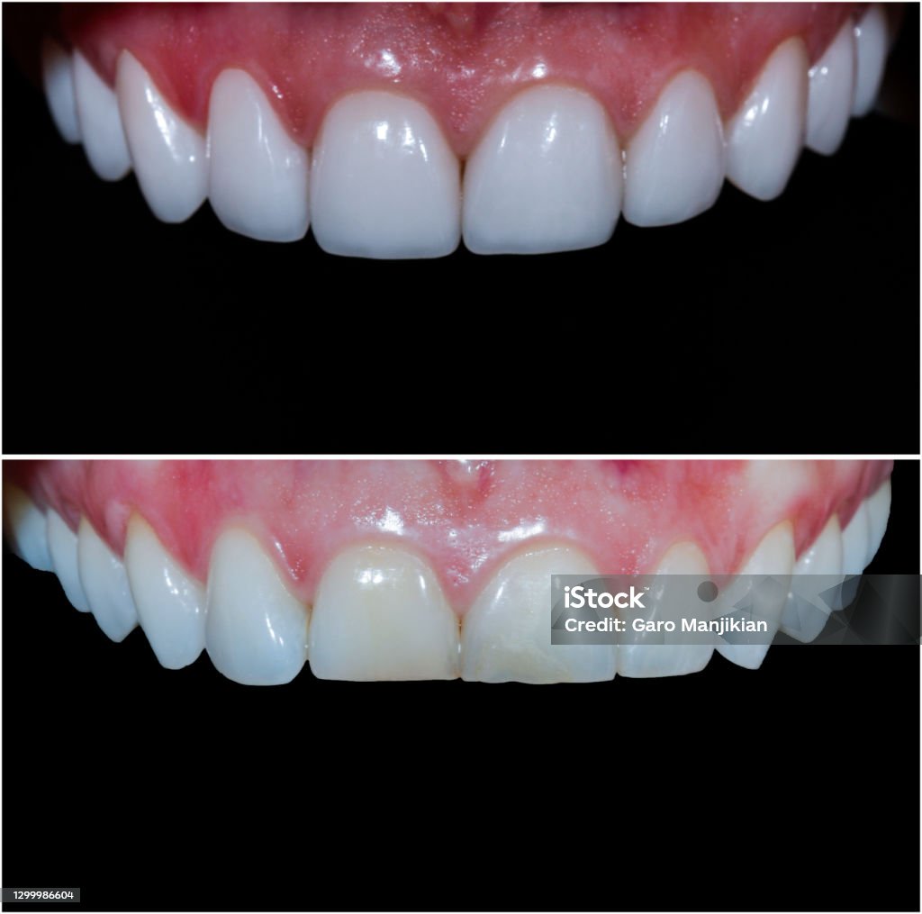 Zahnumformung mit Presskeramikcrwons und Vennern - Lizenzfrei Veneer - Zahnbehandlung Stock-Foto