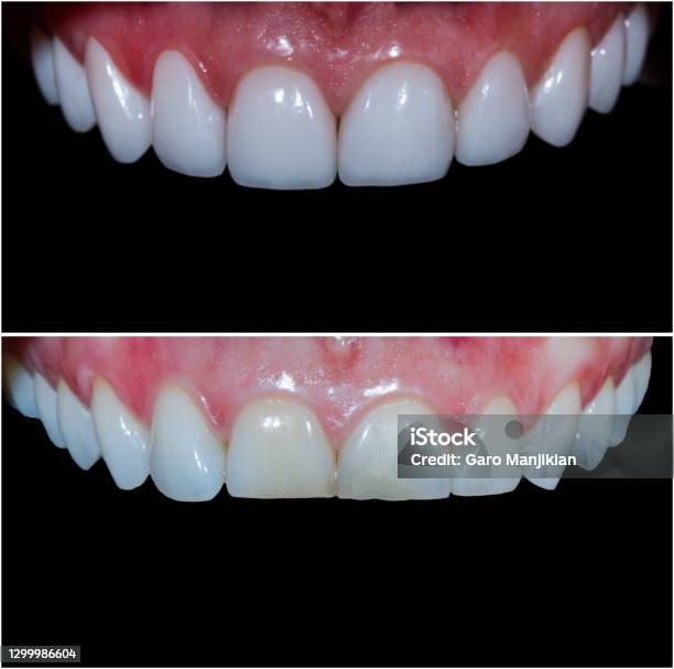 Zahnumformung Mit Presskeramikcrwons Und Vennern Stockfoto und mehr Bilder von Veneer - Zahnbehandlung - Veneer - Zahnbehandlung, Zahn, Zahnpflege