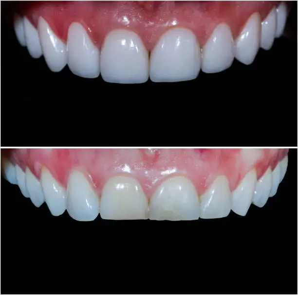 teeth reshaping with press ceramic crwons and venners