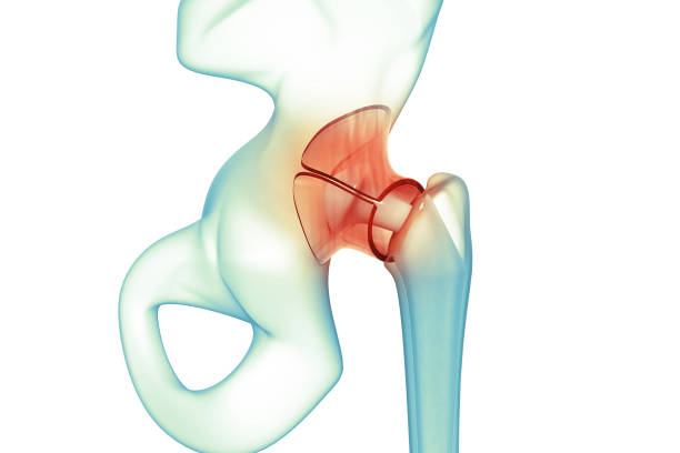 istock Human hip joint injury. 3d illustration 1300092168