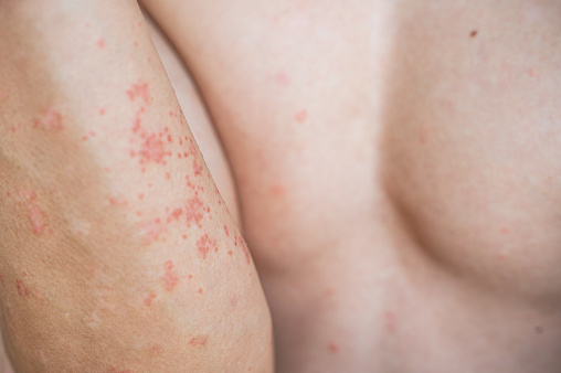 A close-up of Close-up allergic dermatitis eczema skin man patient