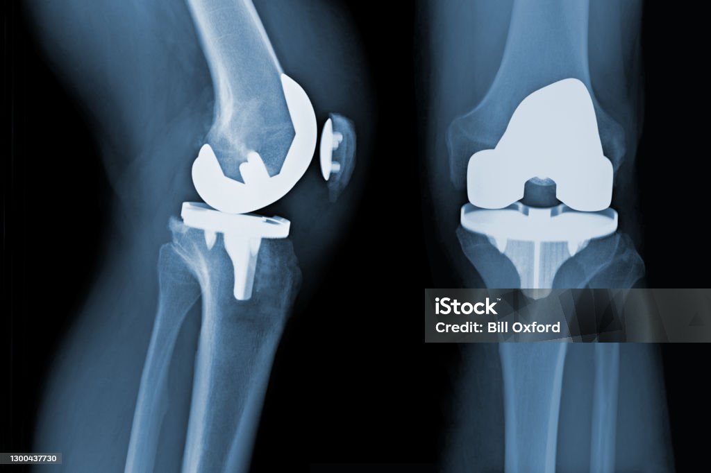 Total Knee Replacement X-ray - osteoarthritis
Before Total Knee Replacement X-ray - osteoarthritis Total Knee Replacement X-ray - osteoarthritis knee repair Implant Stock Photo