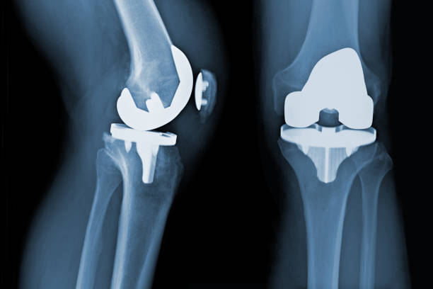 Total Knee Replacement X-ray - osteoarthritis
Before Total Knee Replacement X-ray - osteoarthritis Total Knee Replacement X-ray - osteoarthritis knee repair artificial knee photos stock pictures, royalty-free photos & images
