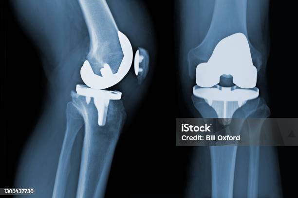 Total Knee Replacement Xray Osteoarthritis Before Total Knee Replacement Xray Osteoarthritis Stock Photo - Download Image Now
