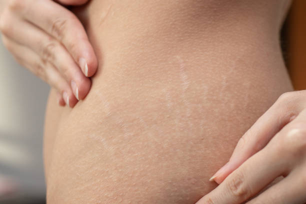 istock Woman hips with visible stretch marks 1300473198