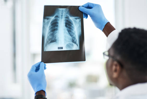 The answer is hidden between the lines Shot of a young doctor analysing an x ray of a patient’s chest bronchitis stock pictures, royalty-free photos & images