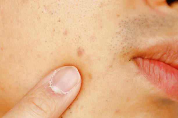 Acne scars on Japanese man stock photo