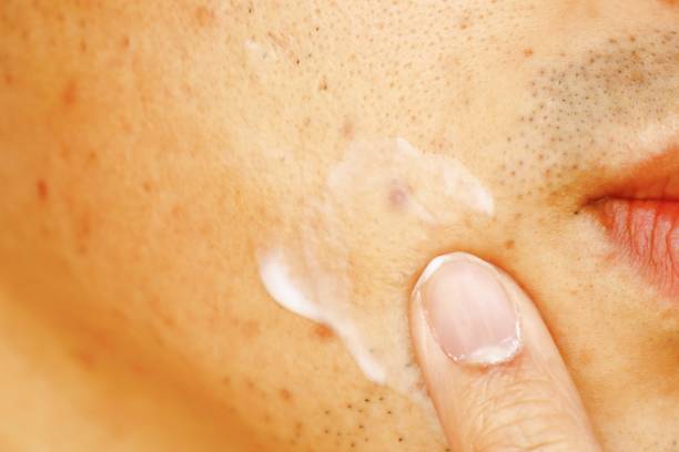 istock Acne scars on Japanese man 1300622646