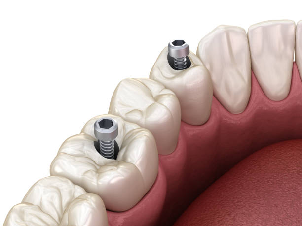 istock Premolar and Molar tooth crown installation over implant, screw fixation. 3D illustration of dental treatment 1300662788