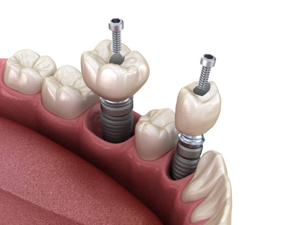 istock Premolar and Molar tooth crown installation over implant, screw fixation. 3D illustration of dental treatment 1300662794