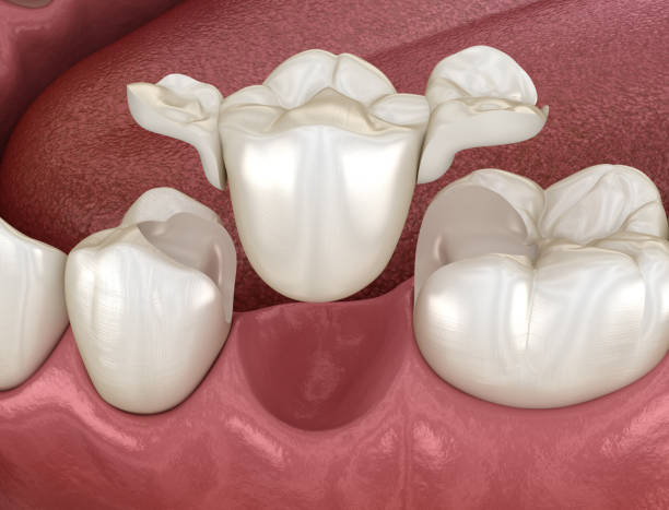istock Maryland bridge made from ceramic, premolar tooth recovery. Medically accurate 3D illustration of dental concept 1300662813