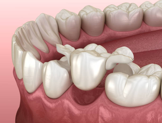 istock Maryland bridge made from ceramic, premolar tooth recovery. Medically accurate 3D illustration of dental concept 1300662814