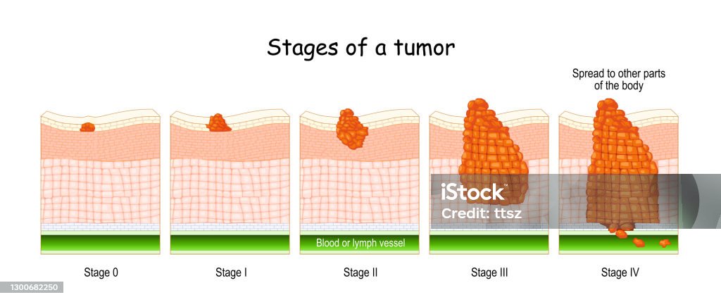 stages of cancer. Classification of Malignant Tumours stages of cancer. Classification of Malignant Tumours (from 0 to 4). system that is most commonly used for the staging process of cancer Colorectal Cancer stock vector