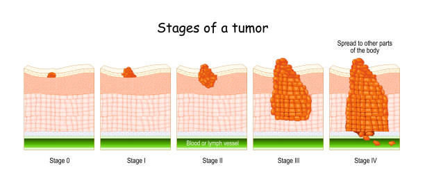 stages of cancer. Classification of Malignant Tumours stages of cancer. Classification of Malignant Tumours (from 0 to 4). system that is most commonly used for the staging process of cancer colon cancer screening stock illustrations