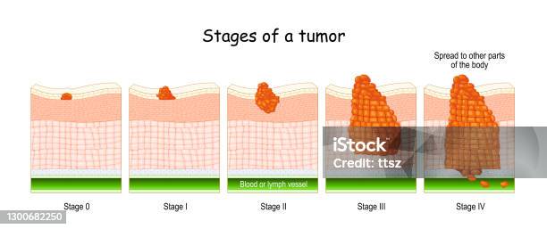 Stages Of Cancer Classification Of Malignant Tumours Stock Illustration - Download Image Now