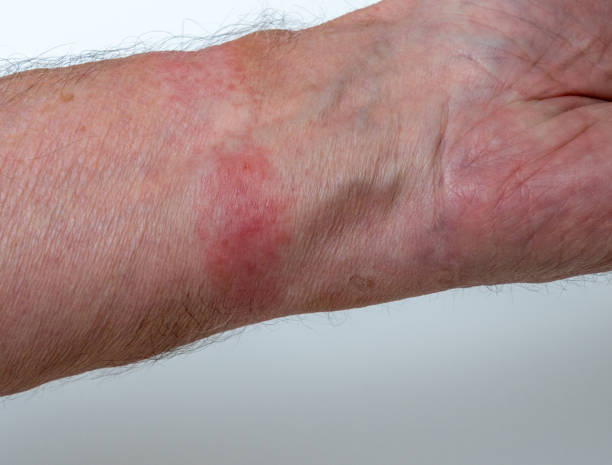 istock Contact allergy skin irritation from wearing a watch strap 1300687909