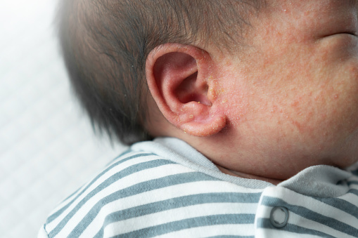 Close up Asian Newborn baby boy with Common skin rash on his face and ear.