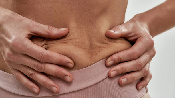 istock Slim middle aged caucasian woman compressing skin 1300780194