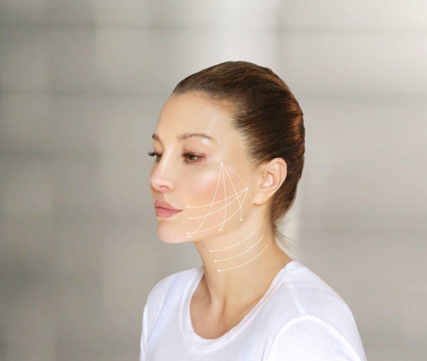 istock Thread Lift ,markup, thread-lift procedure for facial rejuvenation. 1300781308