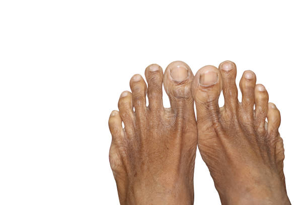istock Human Dry Skin Feet In White Background 1300791341
