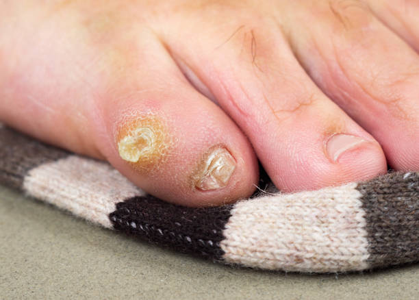 großer trockener callus und falsch geformter nagel auf den kleinen fuß des mannes. folgen des tragens unbequemer, enger schuhe. - podiatry chiropody toenail human foot stock-fotos und bilder