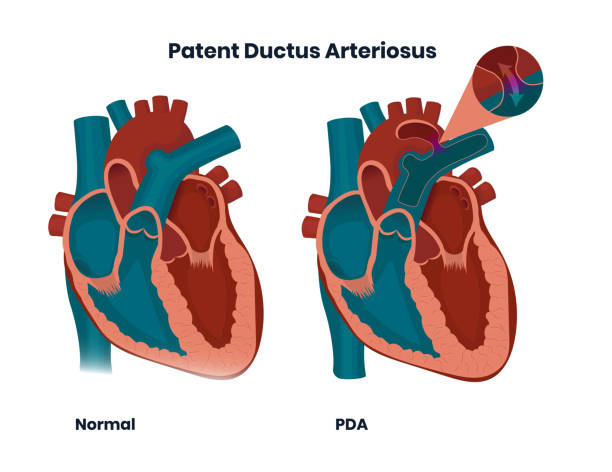 kanał patentowy arteriosus z normalną anatomią serca. ilustracja wrodzonej anomalii serca - congenital stock illustrations