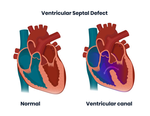 Ventricular septal defect with normal heart anatomy. Illustration of  the congenital heart defect Ventricular septal defect with normal heart anatomy. Illustration of  the congenital defect of the ventricular wall heart ventricle stock illustrations