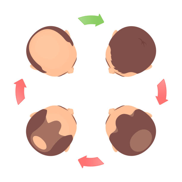 kuvapankkikuvitukset aiheesta kaavio hiustenlähtövaiheista miehillä - receding hairline