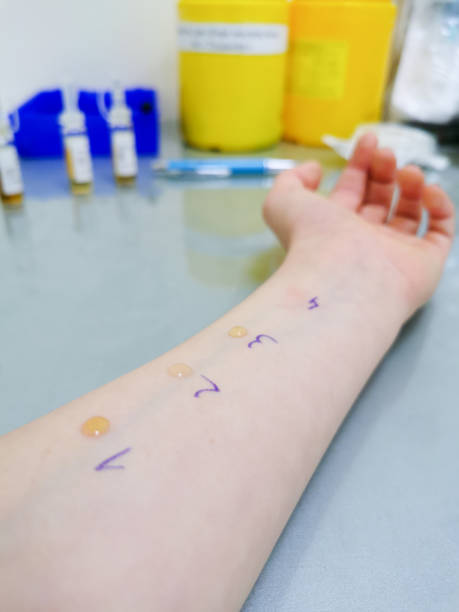 istock Child skin prick allergy test 1300933391