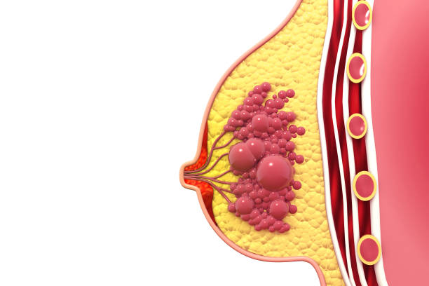 istock Breast cancer, cross section, 3d illustration 1300950764
